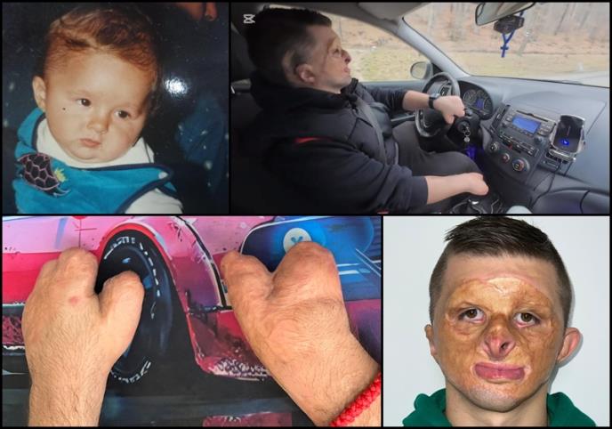 Aleksandar je imao 2 godine kada mu je vatra spržila lice, a ljekari amputirali sve prste na rukama: Bio sam klinički mrtav, ali se desilo čudo!
