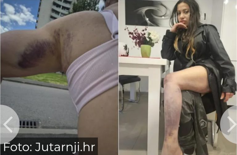 “Teror traje 15 godina” Pjevačica brutalno pretučena, jezive scene u modricama “Manijaci će me osakatiti”
